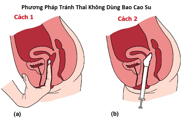 Gel tránh thai VCF vaginal contraceptive quan hệ không cần dùng bao cao su